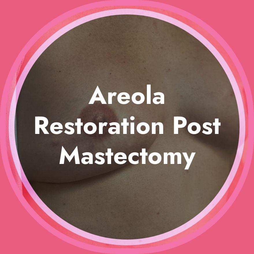 Areola Restoration Post Mastectomy
